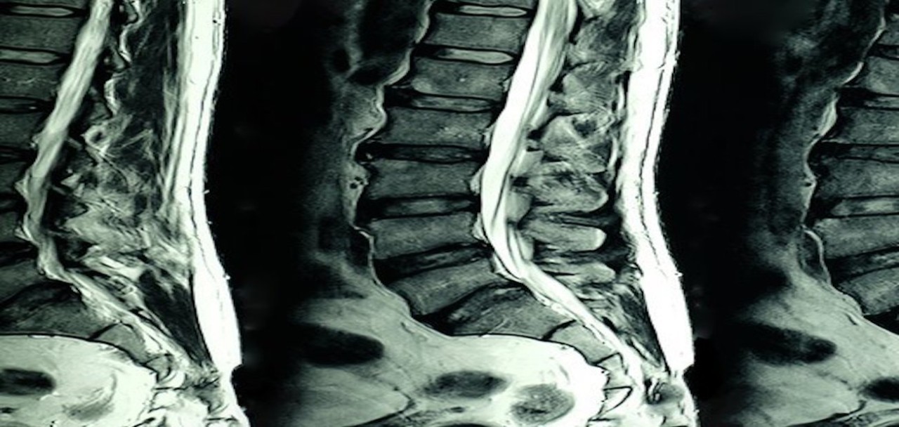 Is Radiofrequency Ablation the Right Treatment For Your Back Pain?